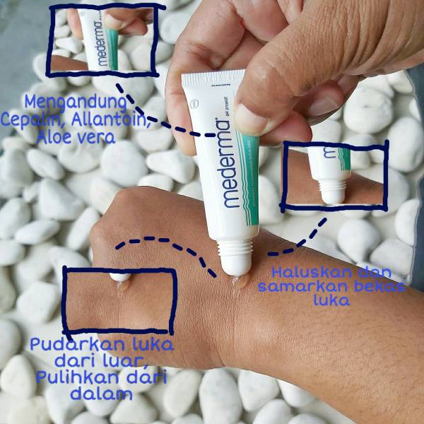 Mederma menyamarkan bekas luka