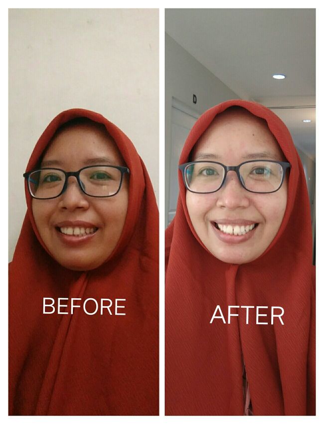Before After Treatment Ella Skin Care Sidoarjo