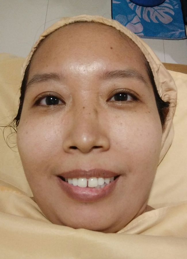 Before Treatment Big Pore