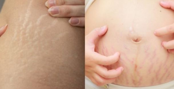 Stretch Mark